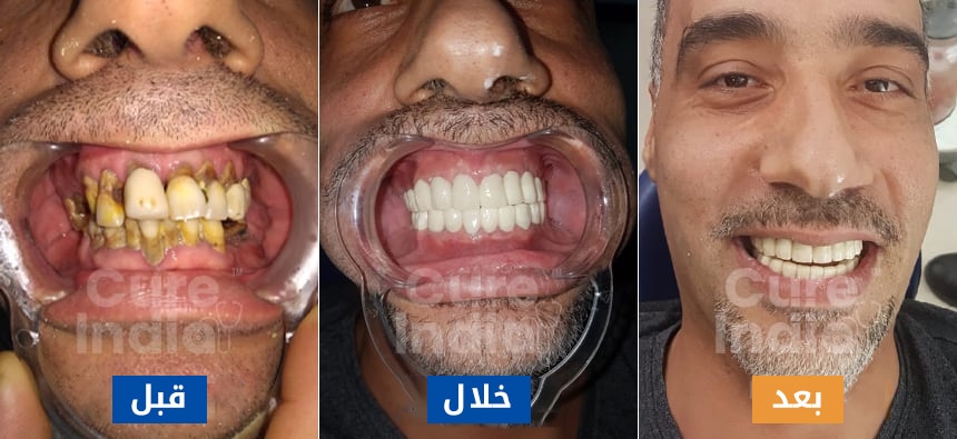 تلبيس الأسنان قبل وبعد الصور